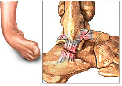 Ankle Sprains in GAA Players - Somerton Physiotherapy Clinic