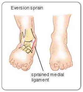 https://somertonphysio.ie/wp-content/uploads/201//0/http-www-mendmeshop-ca-_img-eversion-sprain-jpg.webp