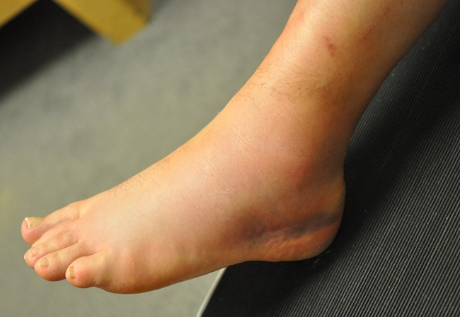 Ankle Sprains in GAA players