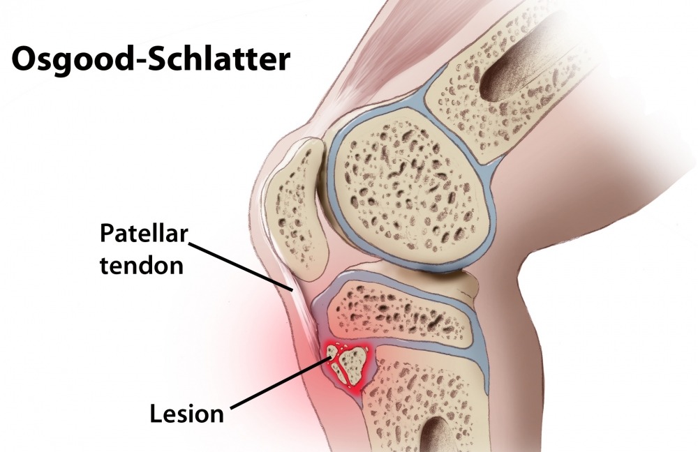 Osgood-Schlatter Disease