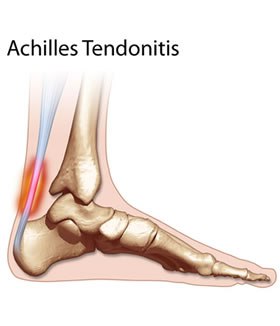 pain in achilles tendon