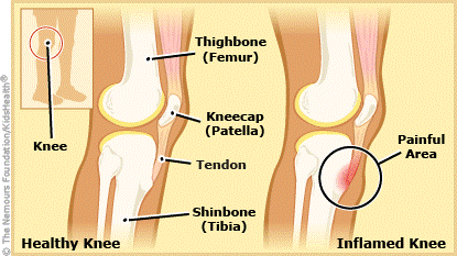 Physiotherapy for Knee Pain - Somerton Physiotherapy Clinic