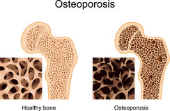 osteoporosis - Physiotherapy Dublin