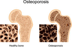 What is Osteoporosis