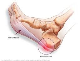 plantar fascitis - Physiotherapy Dublin