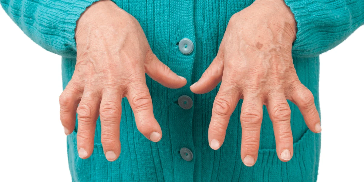 Rheumatoid Arthritis min