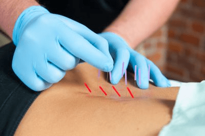 dry-needling