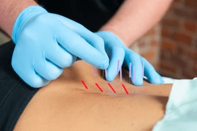 dry needling image 2