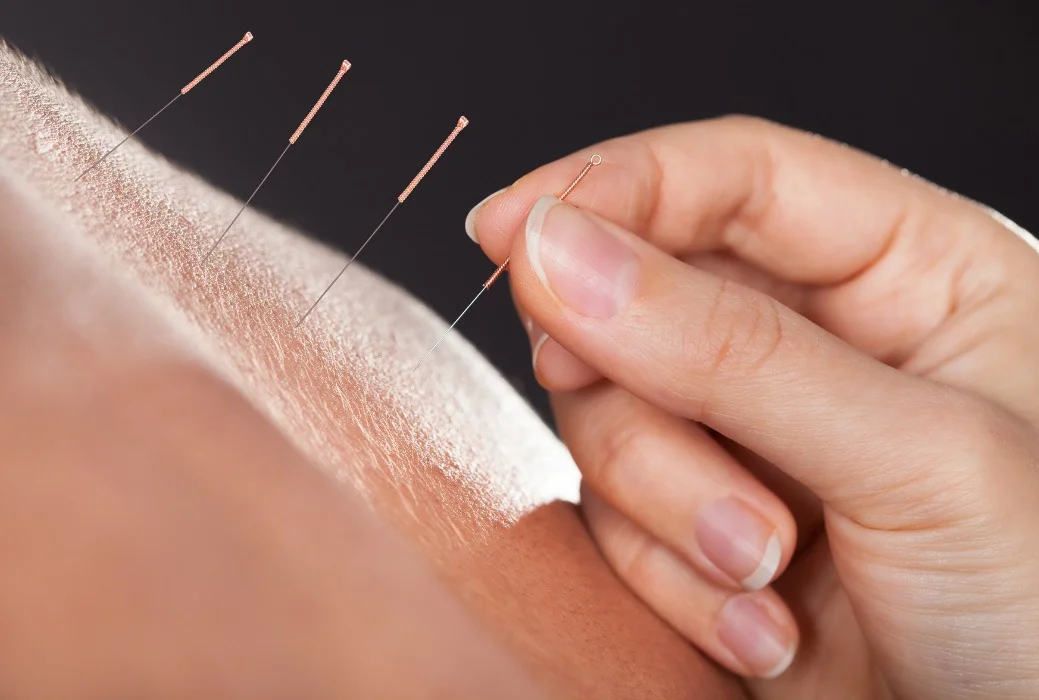 Dry Needling