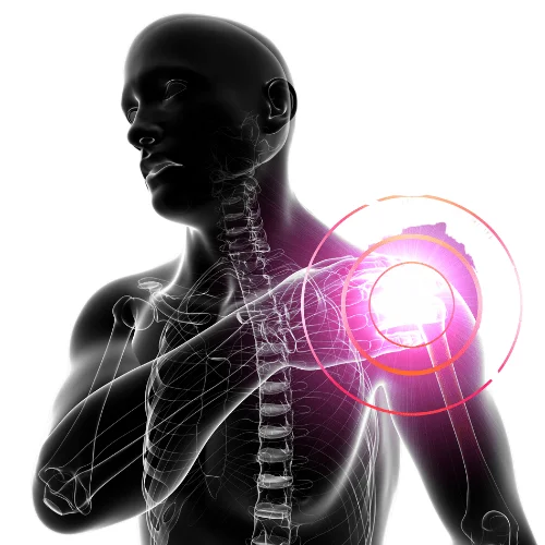 frozen shoulder image