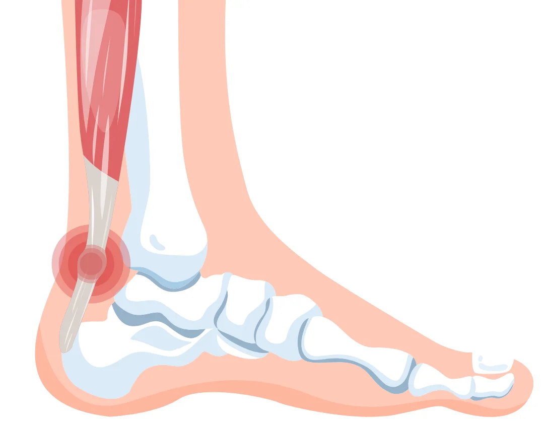 achilles pain image 1
