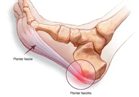 plantar image 1