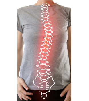 Visual representation of scoliosis showing an abnormal spinal curve on a person’s back.