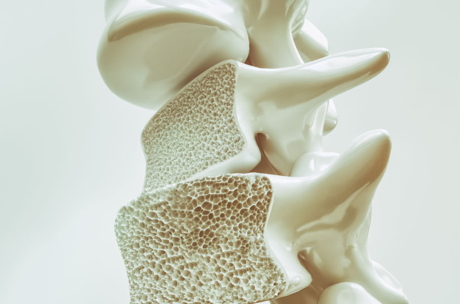 Osteoporosis and Falls