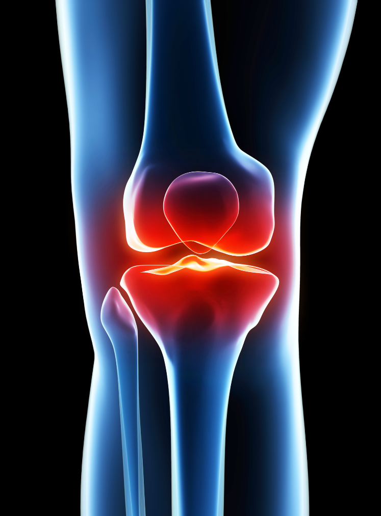 Total Knee Replacement