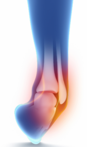 I’ve Sprained My Ankle – What Should I Do Next?